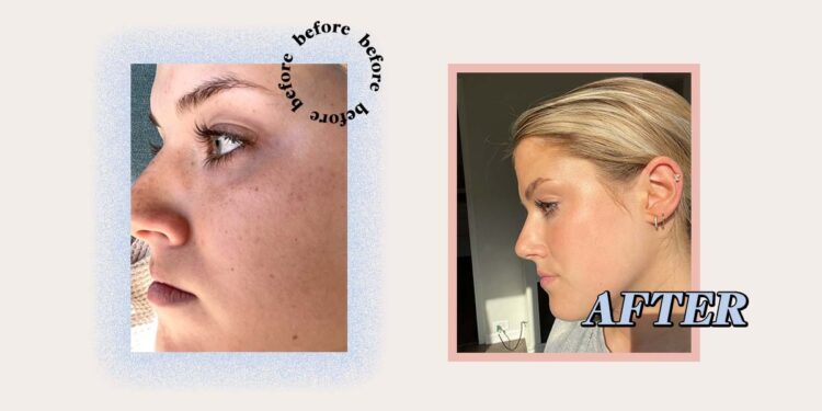 IPL Treatment Review: Everything You Need to Know