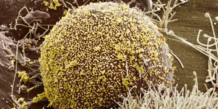 A Woman Is Cured of H.I.V. Using a Novel Treatment