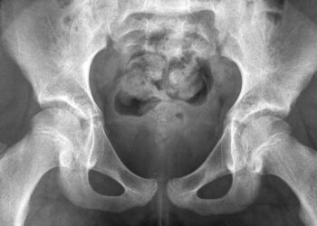 What Pregnancy and Childbirth Do to the Bodies of Young Girls